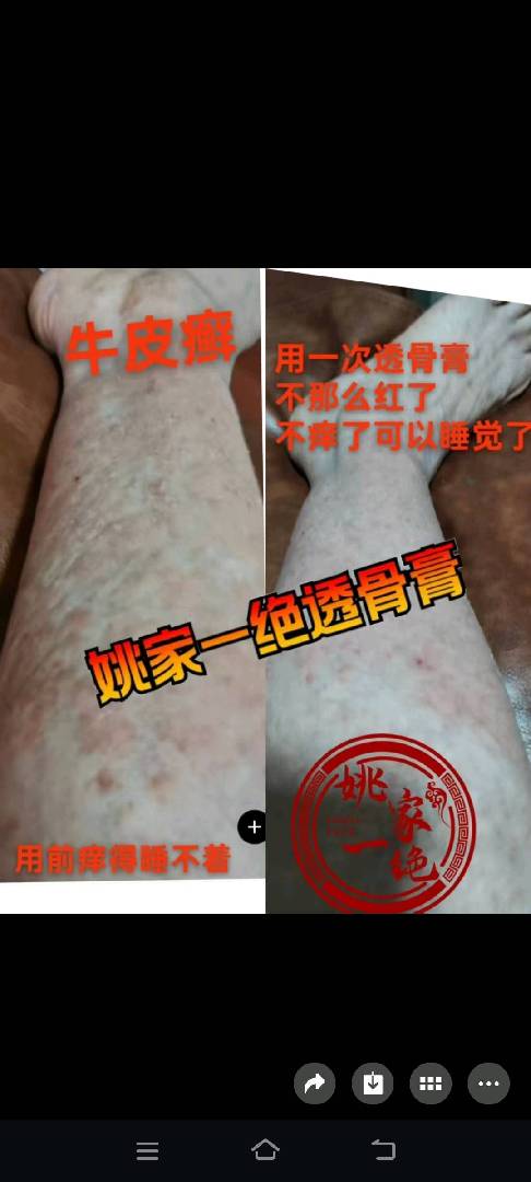 调理老寒腿，月子病！各种寒湿 图片