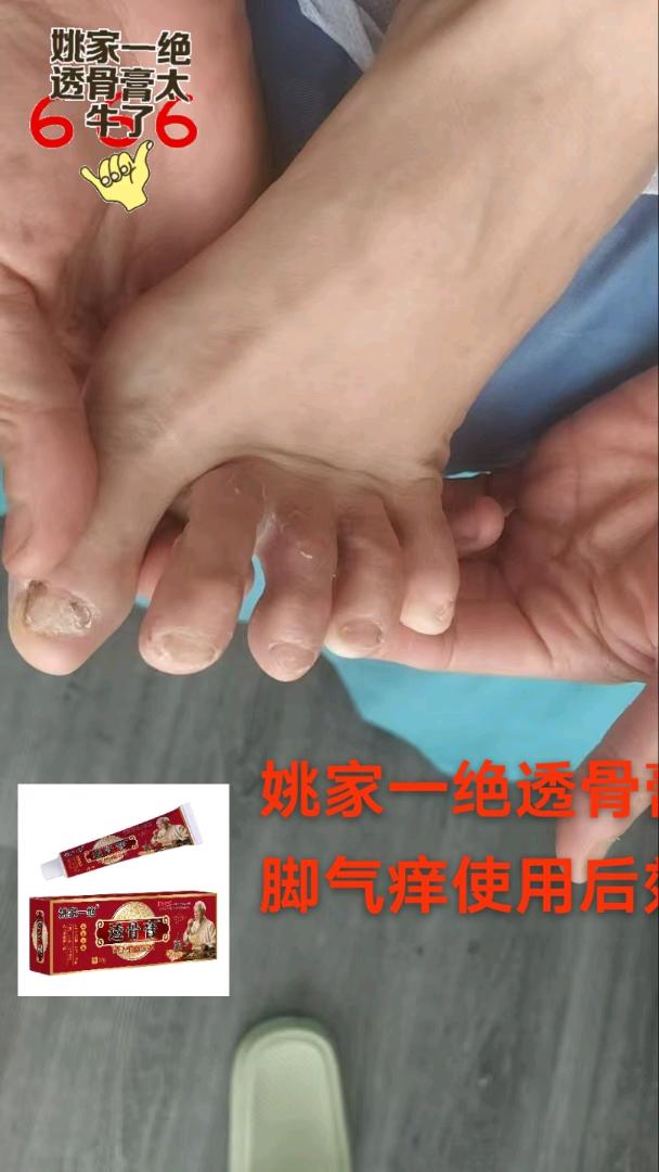 🌈通山脚气效果只要出摊就是那么火爆 痛症产品的黑马产品 图片