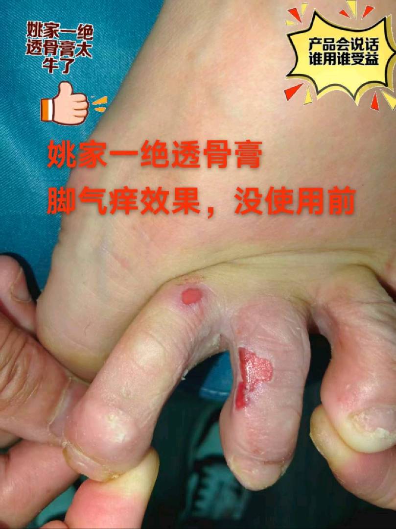 脚气四天效果？？？！ 图片
