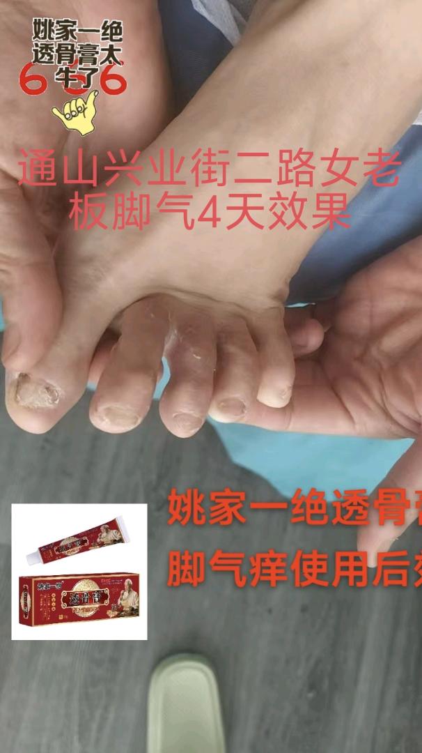 膝盖滑膜炎福音！姚家一绝透骨膏亲测有效，一支使用8天，疼痛完 图片